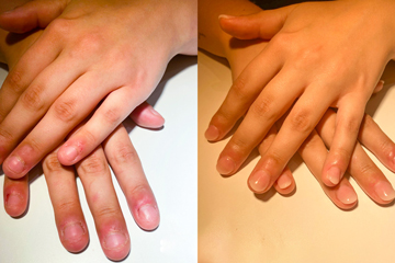 Gel Manicure nail biting before and after