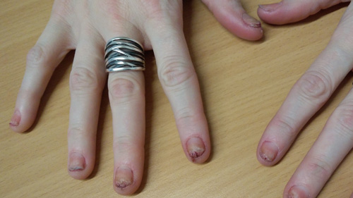 Nails allergy