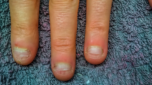 Nails nailbiting before gel nails
