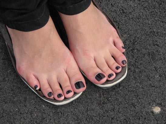 Black toenails