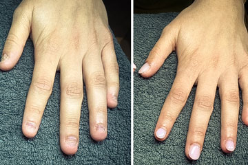 Gel Manicure Nail biting Before & After