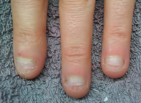 Nailbiter before gel nails
