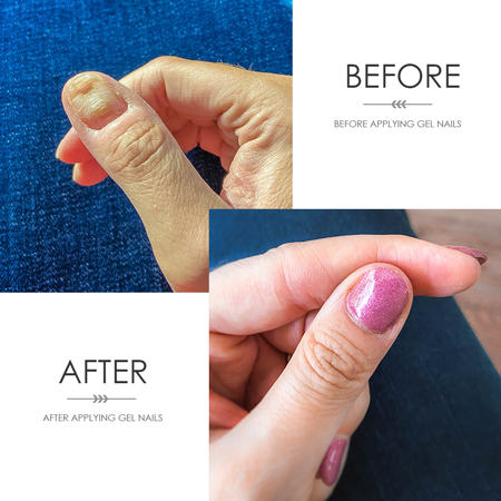 Psoriasis naails gel manicure