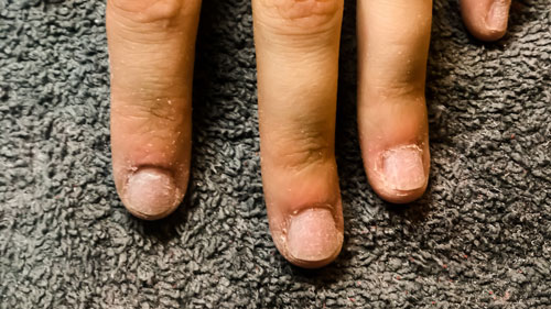Nagelbijter afgekloven nagels