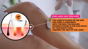 How does laser hair removal work?