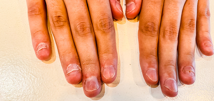 Nagelbijter afgekloven nagels