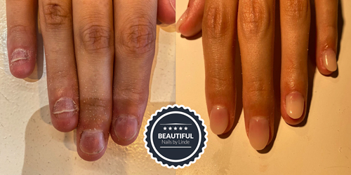 Nail biter before and after gel nails