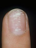 Witte vlekken nagels